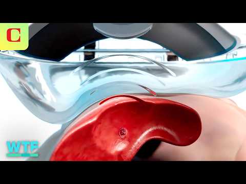 Destroying Tumors with SOUND: Histotripsy Demo &amp; Explainer