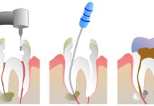 Rotfyllning – Dolt hot mot vår hälsa som varit känt över 100 år rotfyllning Root canals