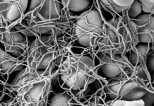 Fibrösa spikproteinproppar funna hos barn till vaccinerade mödrar biologiska strukturer maskliknande blodproppar covidsprutan covidvaccin är dödsorsaken fiberartade blodproppar i lik vita klumpar hos vaccinerade spikproteinproppar