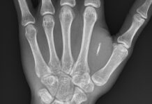 Bank-insider varnar för att CBDCs kommer att implanteras med chip implanteras med chip CBDCs will be Implanted