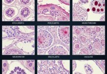 ”Vaccinerad – avliden” – Histopatologisk atlas över dokumenterade skador vållade av coronavaccin Histopatologisk atlas